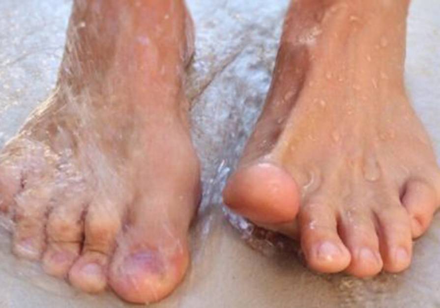 El exceso de calor y la humedad principales causas de la aparición de hongos en los pies en verano