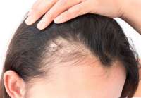 Un 30% de los casos de alopecia en España afectan a mujeres