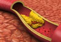 La aterosclerosis, derivada del colesterol alto, provoca el 85 % de las muertes relacionadas con las enfermedades circulatorias