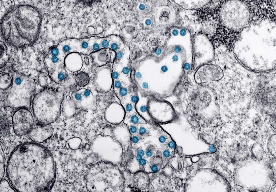 Partículas del virus SARS-CoV-2, coloreadas en azul, en una imagen de microscopio de electrones