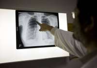 Los casos de tuberculosis descienden un 13% en los últimos cuatro años en la Comunitat Valenciana