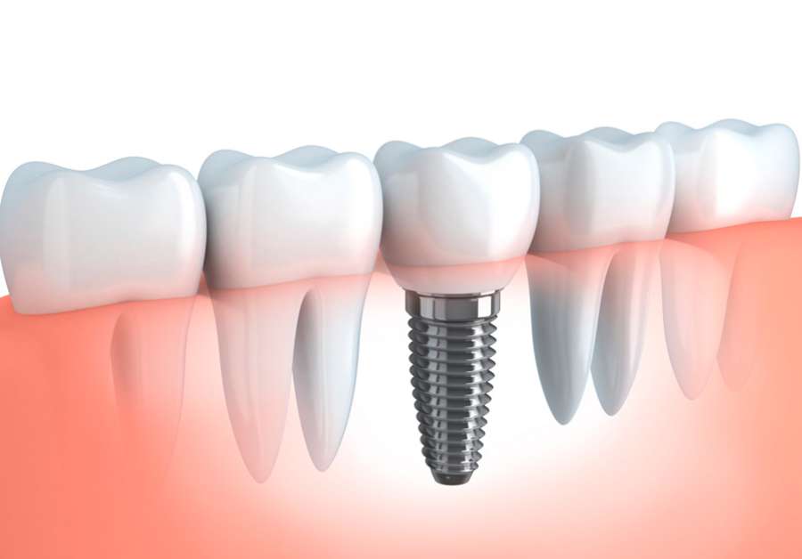 El 25% de los pacientes con implantes dentales desarrolla un proceso inflamatorio a medio plazo