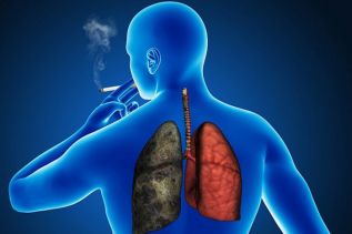 El 90% de las muertes por cáncer de pulmón en hombres y el 71% en mujeres son atribuibles al consumo de tabaco