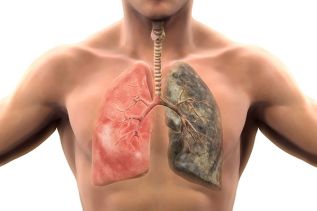 Se detectan más de 2.800 nuevos casos de cáncer de pulmón cada año