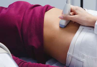 El Síndrome de Ovarios Poliquísticos es el trastorno reproductivo que más afecta a las mujeres en edad fértil
