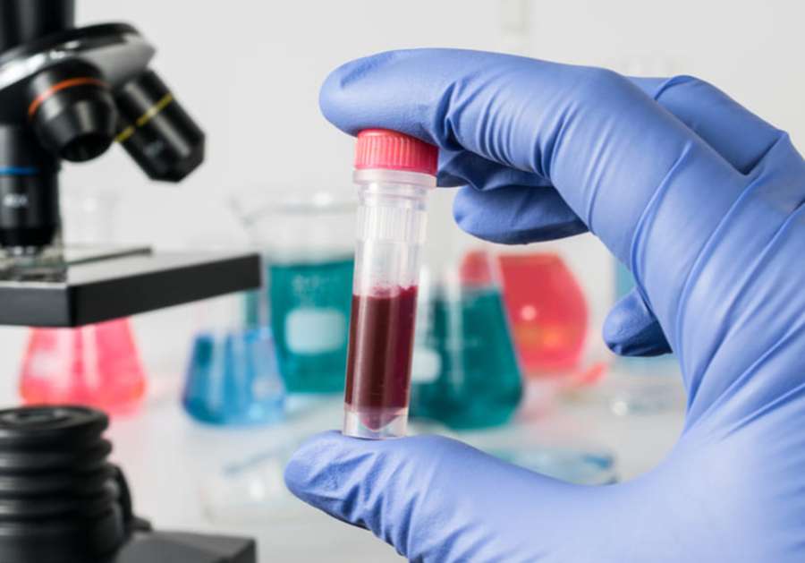 Identifican con un análisis de sangre una molécula que anticipa qué pacientes con lupus pueden terminar sufriendo daño renal