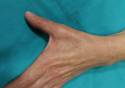 El síndrome del túnel carpiano y otros nervios de la mano, se ven agravados por la COVID-19