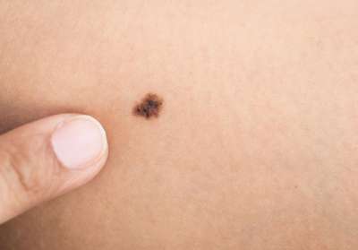 La Comunitat Valenciana registra 574 nuevos casos de melanoma en un año
