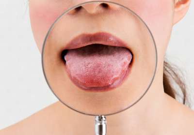 El síndrome de la boca ardiente afecta especialmente a mujeres menopáusicas o posmenopáusicas