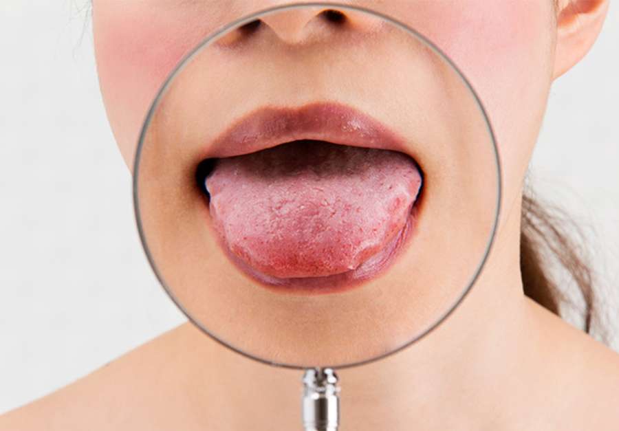 El síndrome de la boca ardiente afecta especialmente a mujeres menopáusicas o posmenopáusicas